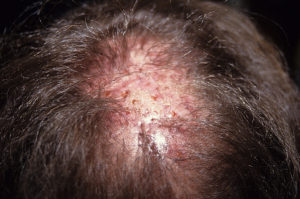 Видимые воспалительные процессы и рубцовая ткань после имплантации искусственных волос на коже головы мужчины