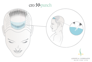 Трансплантация собственных волос с помощью метода «Crosspunch»