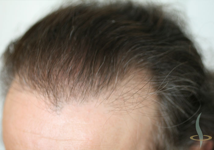 Волосы слева от второй операции