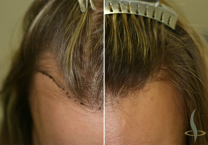 До и после 2-й операции