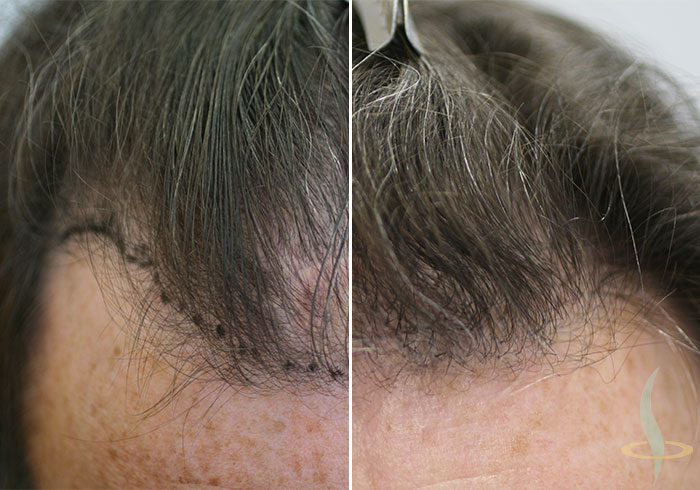 До и после 2-й операции